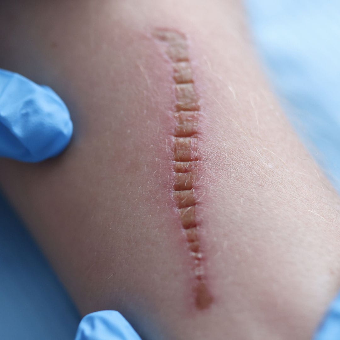 10+ Stages Of Wound Healing For Better Care