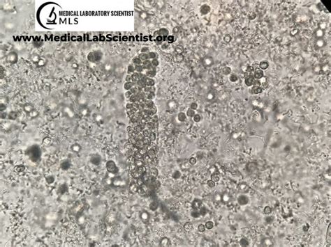 10 White Blood Cell Casts Signs You Should Know