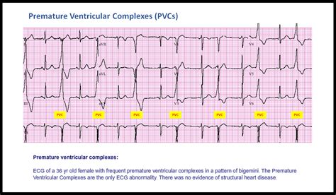 12+ Icd 10 Tips For Accurate Premature Ventricular Complexes Coding
