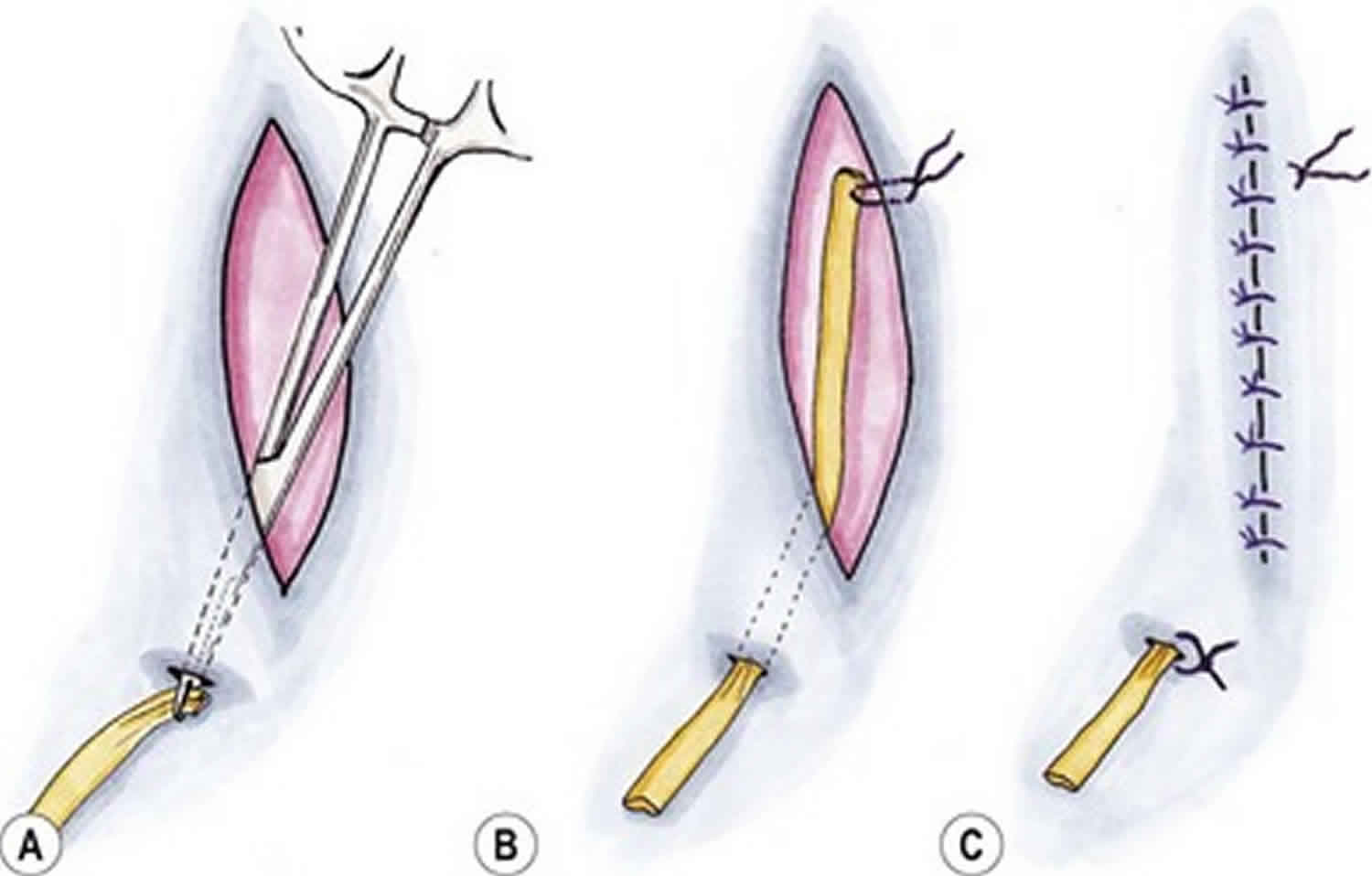 12+ Secrets To Simplify Penrose Drain Removal Pain