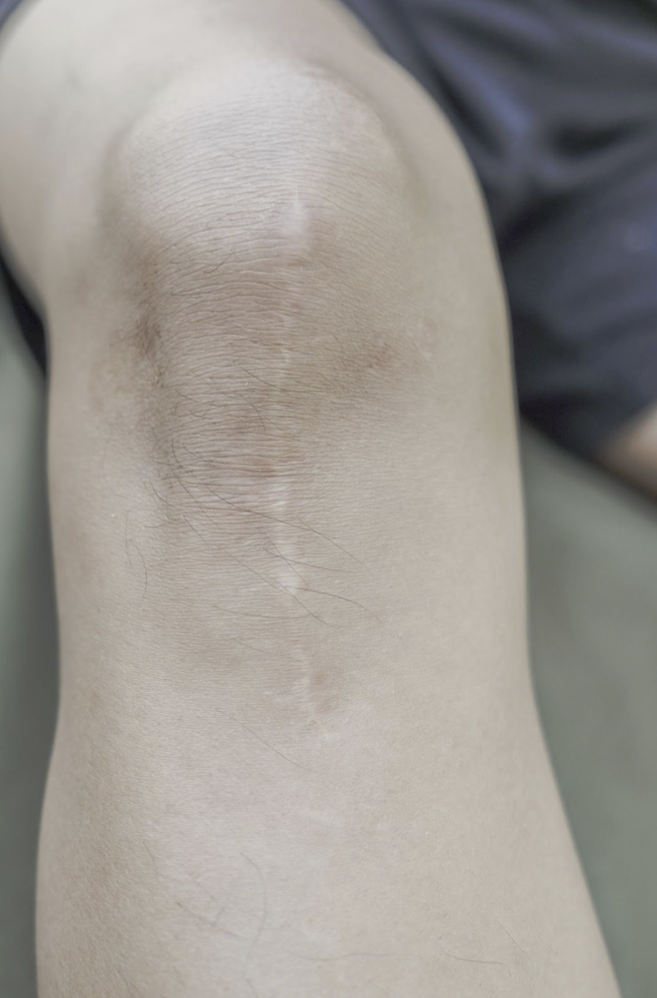 Abdominoplasty Post Op: Minimize Scars
