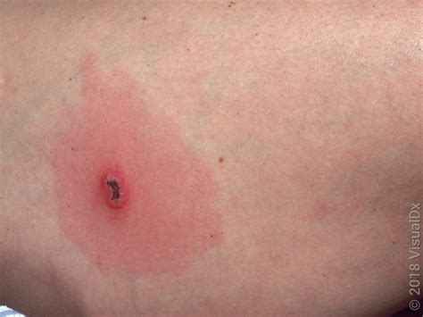 Allergic Reaction Parson Spider Bite Allergic Reaction Parson Spider Bite