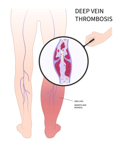 Blood Clot In Calf: Relieve Pain With Simple Steps