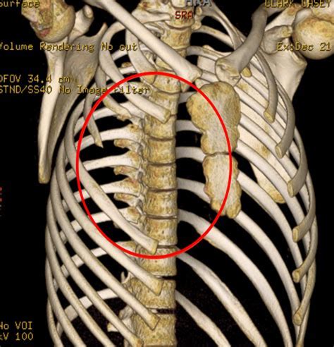 Bone Lump On Rib