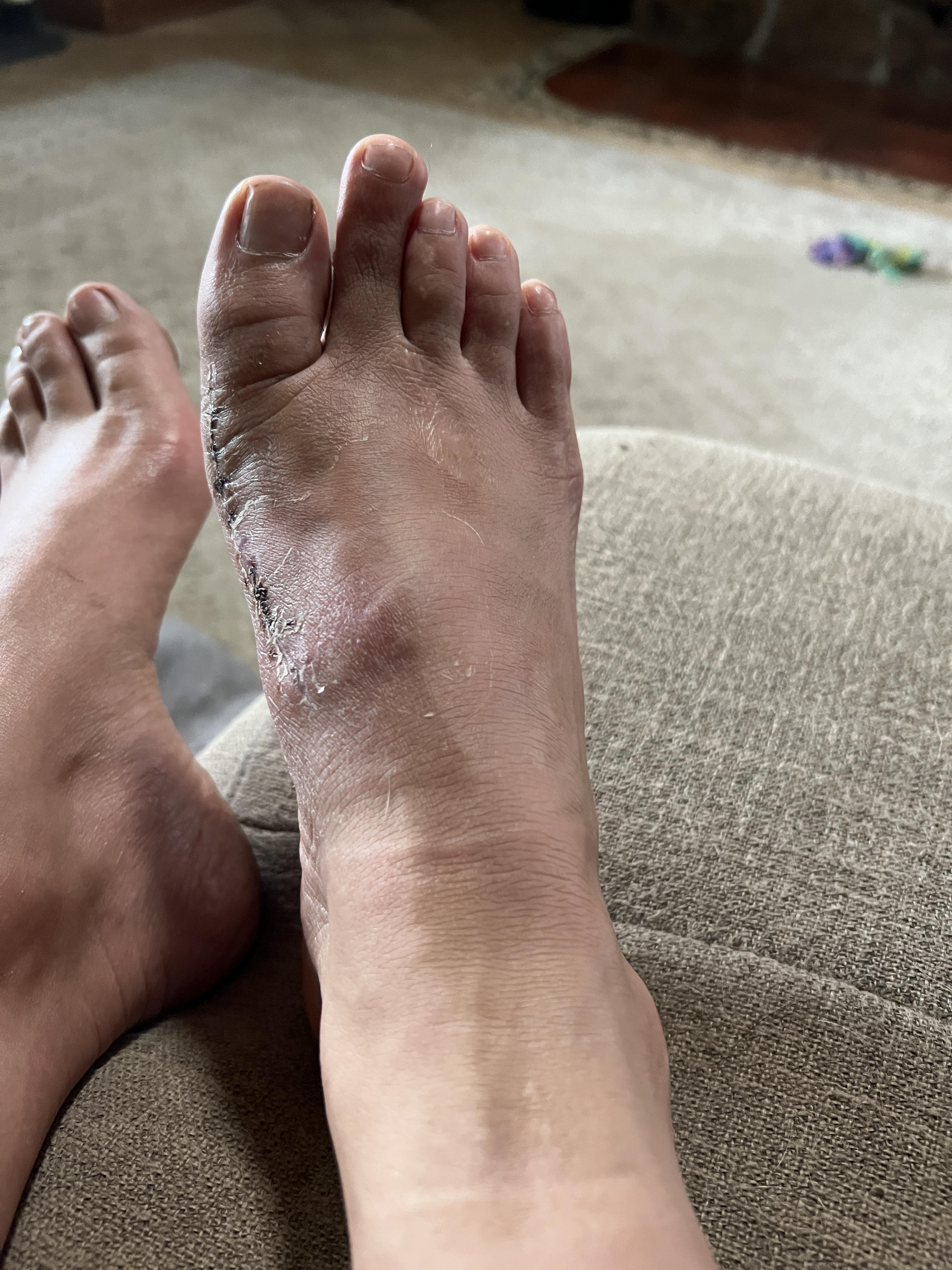 Bunionectomy Swelling