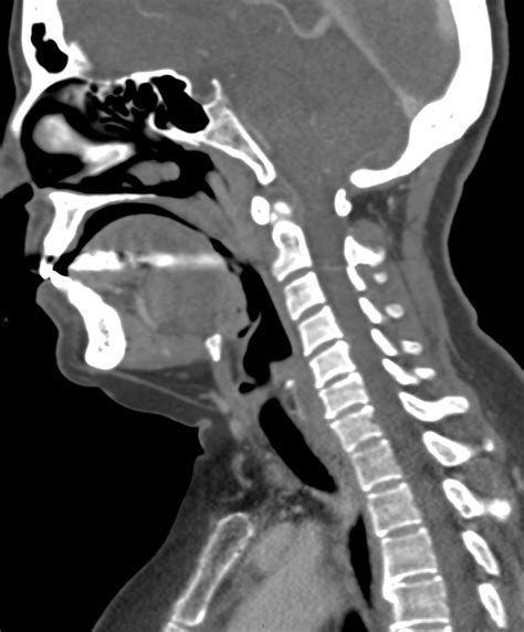 Cat Scan Of The Neck