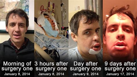 Fractured Jaw: Full Recovery In 3 Months