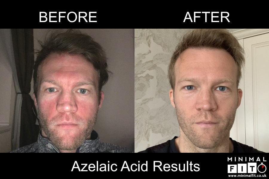How Does Azelaic Acid Work? Clear Skin Guide