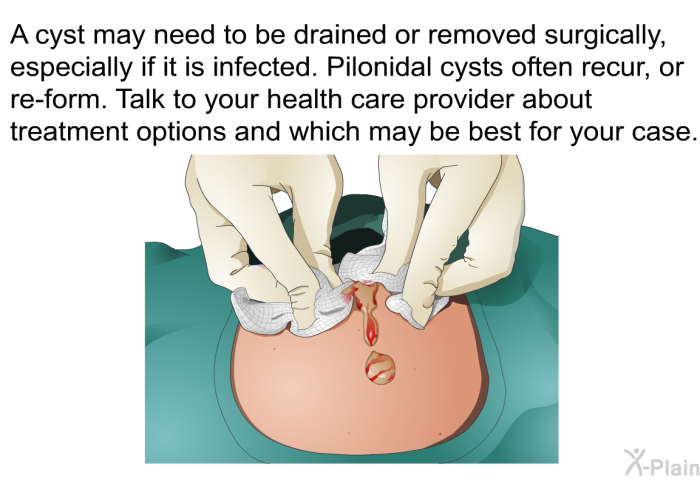 How To Pack Pilonidal Cyst Open Wound? Simple Steps