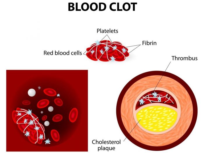 How To Treat Blood Clot In Calf? Home Remedies Inside How To Treat Blood Clot In Calf? Home Remedies Inside