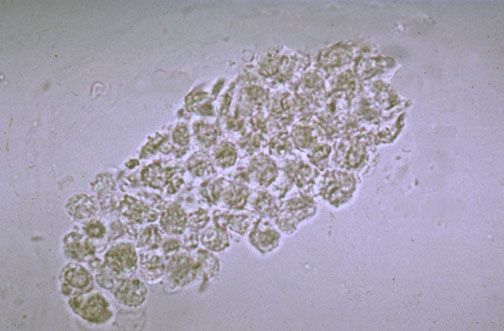 How To Treat White Blood Cell Casts In Urine Naturally