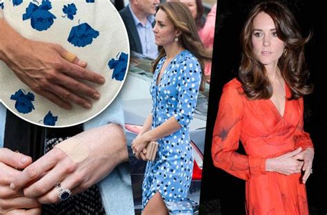 Kate Middleton Bulemia