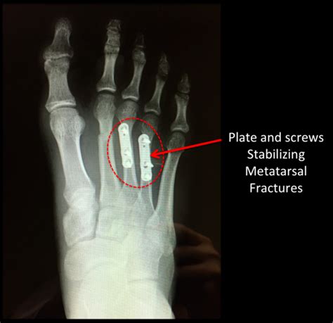 Metatarsal Fracture: Recover In 3 Months Or Less
