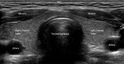 Normal Thyroid Volume On Ultrasound