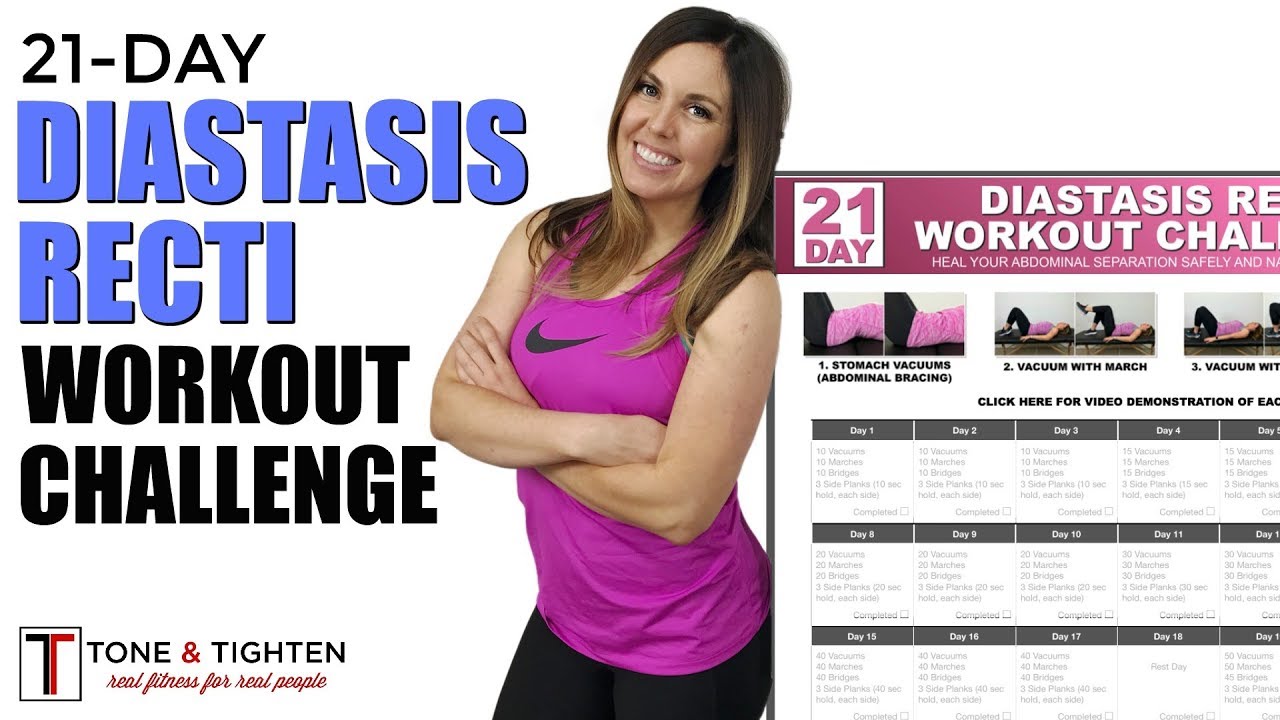 Real Diastasis Recti Pictures