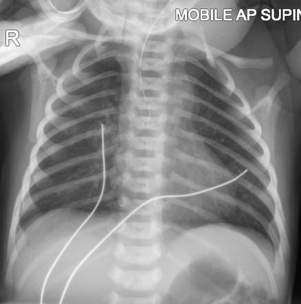 Replogle Tube Vs Nasogastric Tube