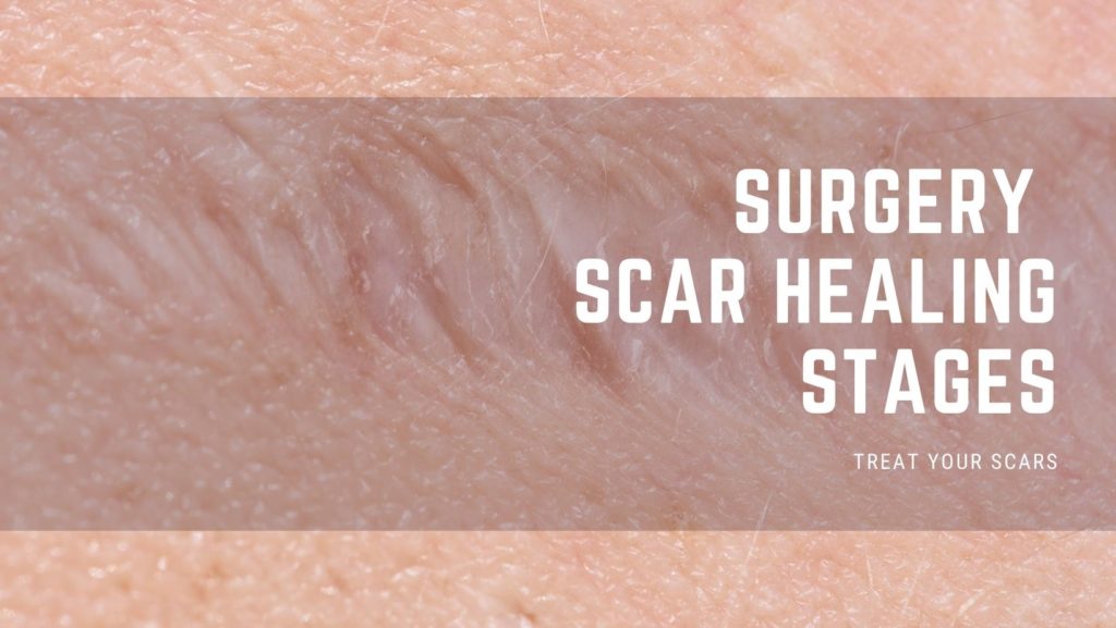 Sistrunk Procedure Scar