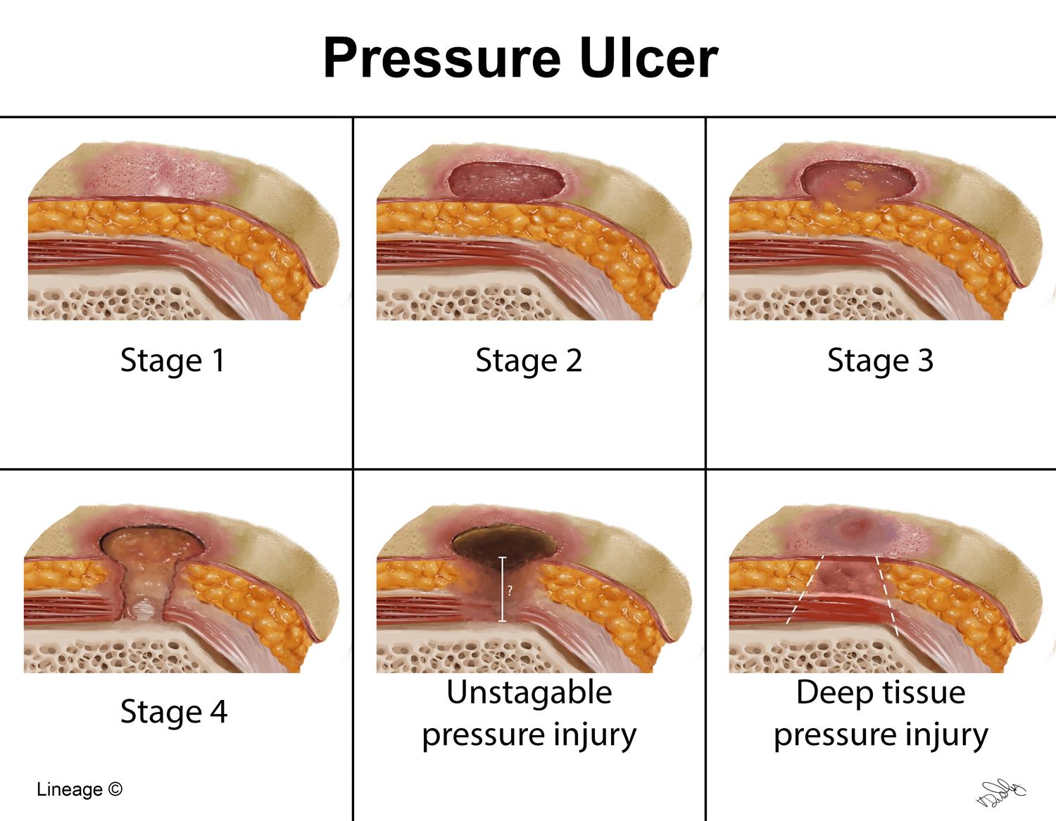 Sloughy Wounds Management: Healing Guide