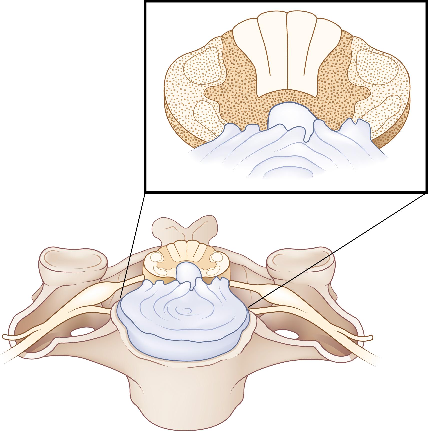 Spinal Cord Trauma In Dogs