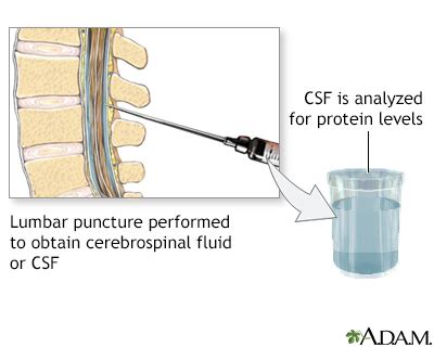 Spinal Fluid Protein High