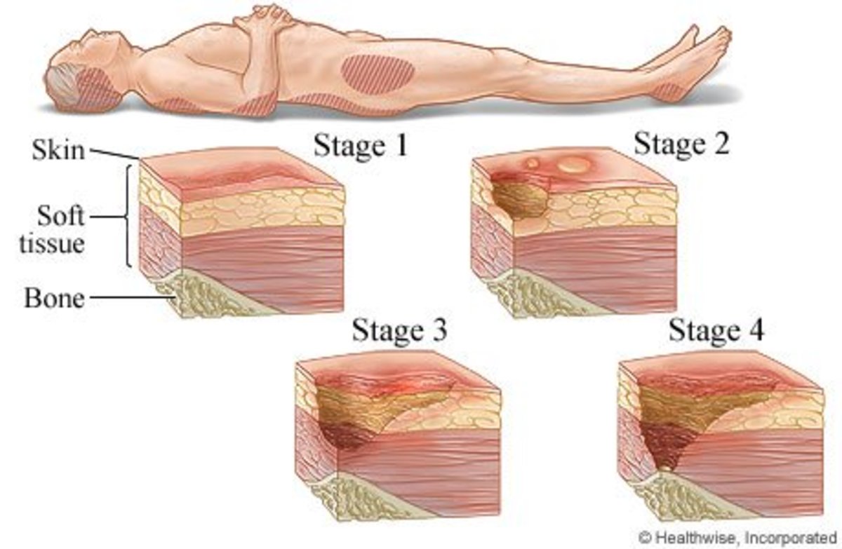 Stage 1 Decubitus Ulcers Pictures