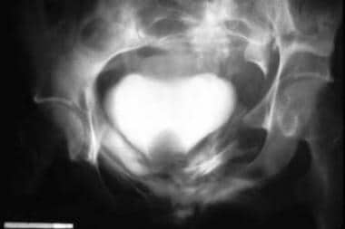 Symptoms Of Burst Bladder