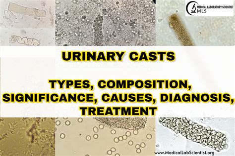 Tubular Casts In Urine