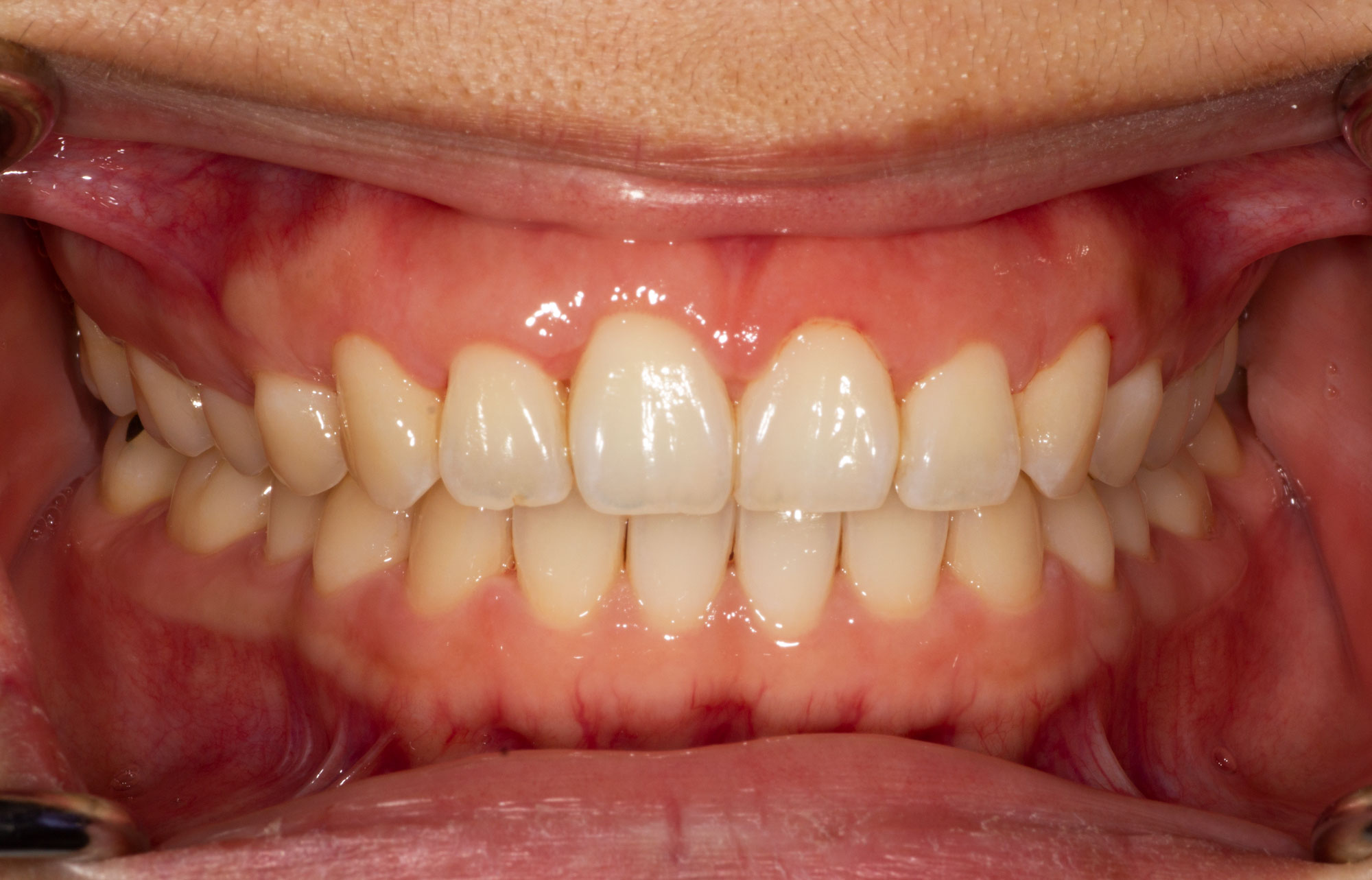 Vitamin C And Gum Disease