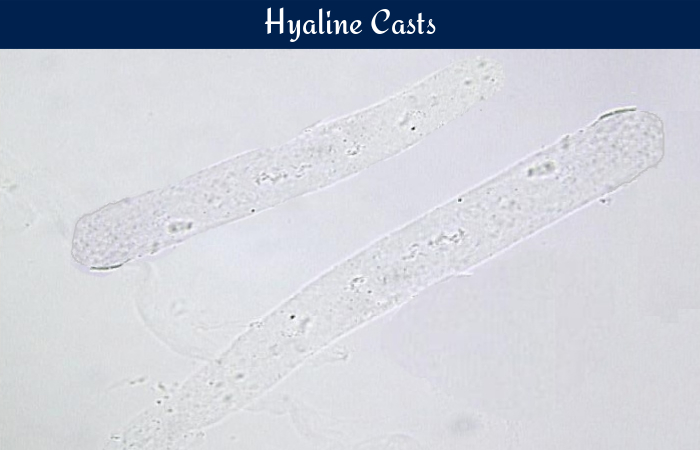 What Are Hyaline Casts? Understand Your Urine Test