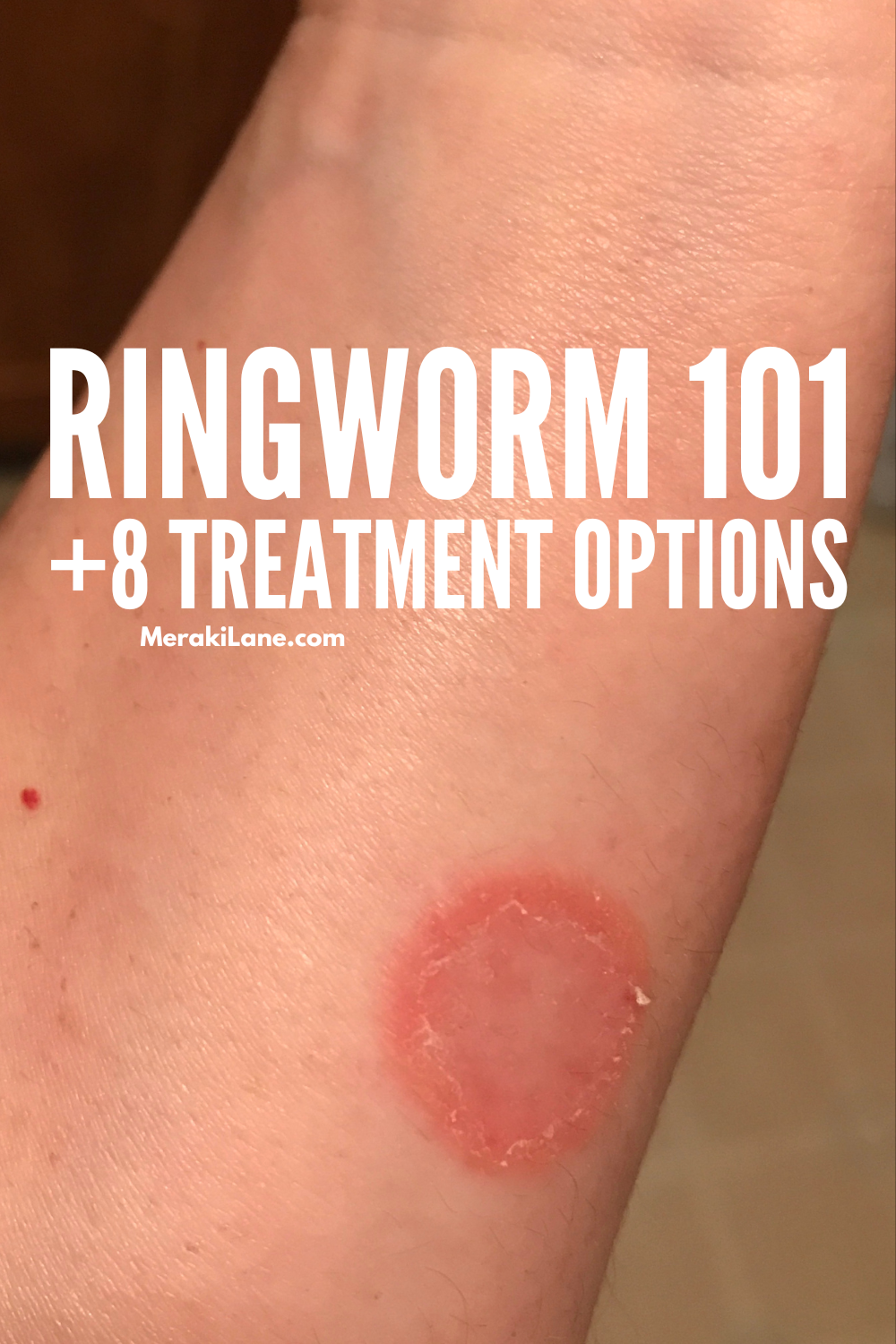 What Causes Ringworm In Sheep? Treatment Options What Causes Ringworm In Sheep? Treatment Options